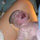 Nástřih hráze při porodu